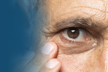 Ceratocone: diagnóstico e tratamento | Clínica Santa Branca